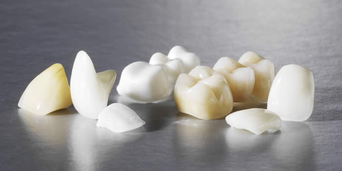 Протезирование зубов безметалловой керамикой