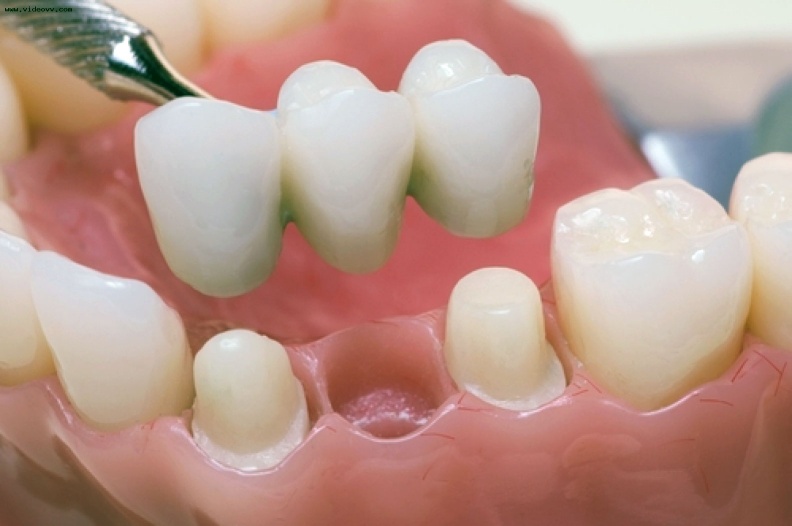 протезирование зубов 