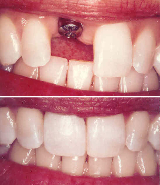 передние зубы до и после имплантации